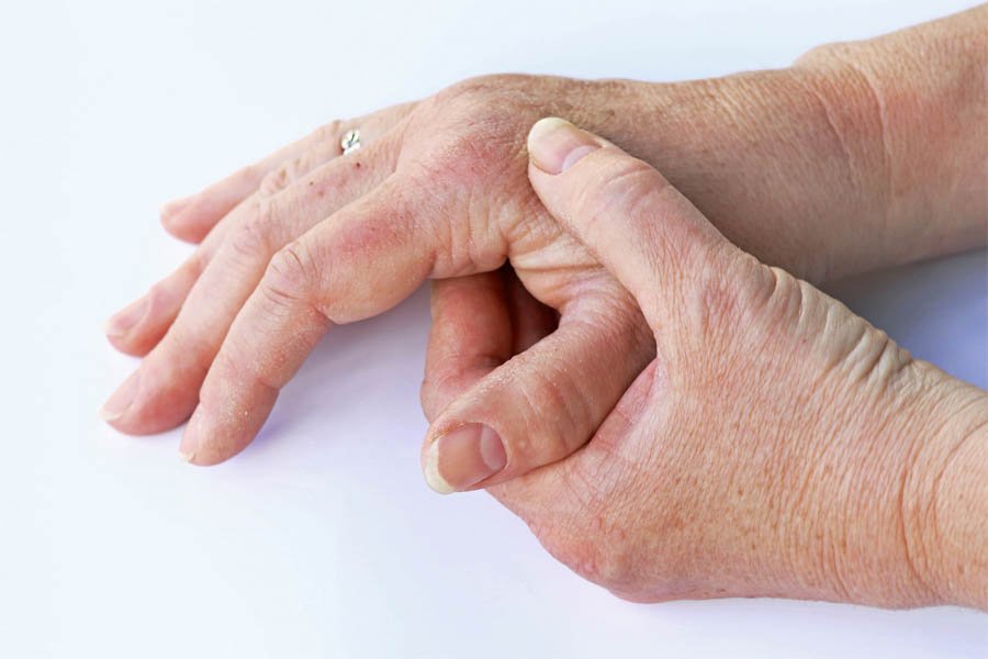 Bệnh Gout Hay Bệnh Gút Là Gì? Nguyên Nhân Và Cách Điều Trị Bệnh Gout