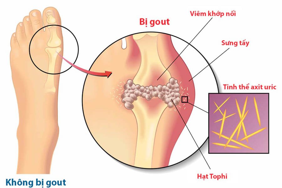 Bệnh Gout Hay Bệnh Gút Là Gì? Nguyên Nhân Và Cách Điều Trị Bệnh Gout
