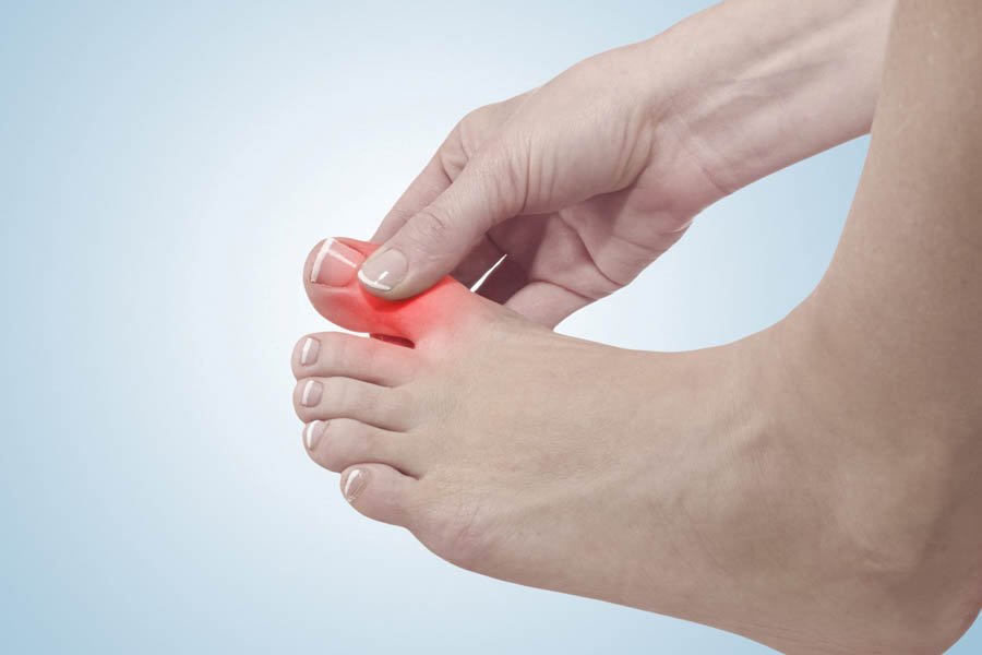 Bệnh Gout Hay Bệnh Gút Là Gì? Nguyên Nhân Và Cách Điều Trị Bệnh Gout