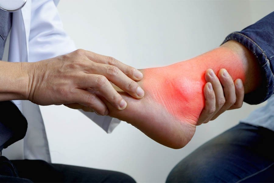 15 Cách Chữa Bệnh Gout Tại Nhà Siêu Hiệu Quả