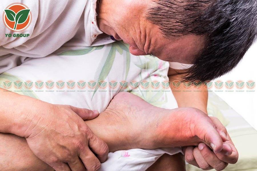 Bật Mí 9 Cách Phòng Ngừa Bệnh Gout Được Chuyên Gia Khuyên Dùng 3 Bật Mí 9 Cách Phòng Ngừa Bệnh Gout Được Chuyên Gia Khuyên Dùng