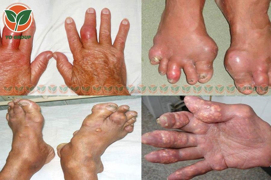 Bật Mí 9 Cách Phòng Ngừa Bệnh Gout Được Chuyên Gia Khuyên Dùng 4 Bật Mí 9 Cách Phòng Ngừa Bệnh Gout Được Chuyên Gia Khuyên Dùng