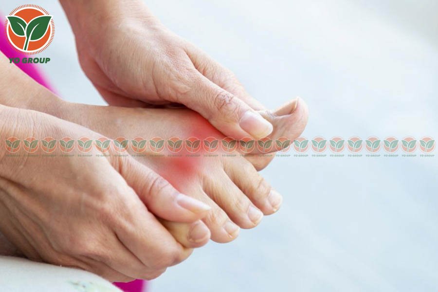 Bật Mí 9 Cách Phòng Ngừa Bệnh Gout Được Chuyên Gia Khuyên Dùng 5 Bật Mí 9 Cách Phòng Ngừa Bệnh Gout Được Chuyên Gia Khuyên Dùng