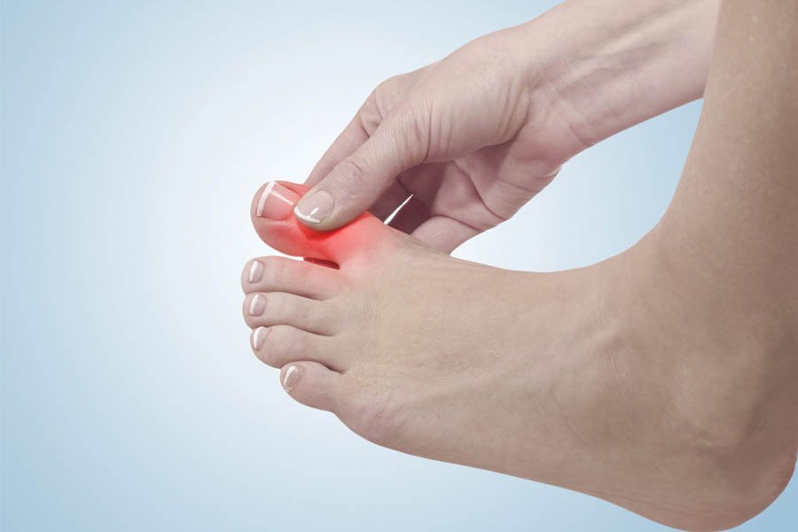 Bệnh Gout Mãn Tính Và Tất Tần Tật Thông Tin Mà Bạn Cần Biết