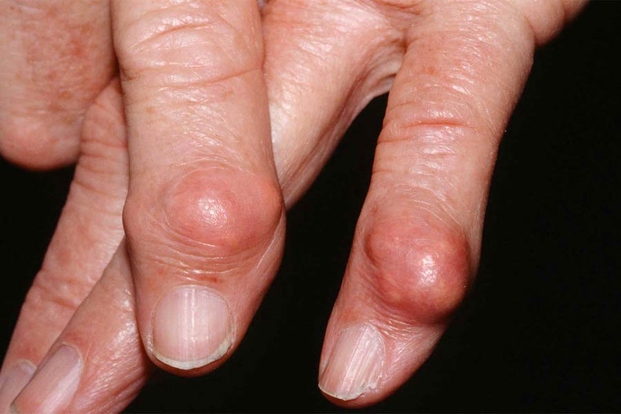 Bệnh Gout Mãn Tính Và Tất Tần Tật Thông Tin Mà Bạn Cần Biết