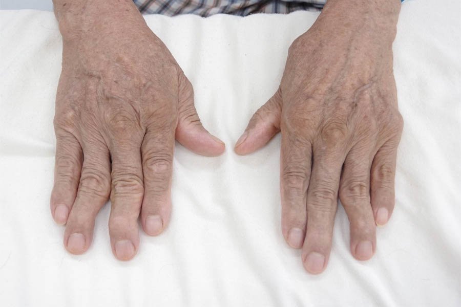 Bệnh Gout Mãn Tính Và Tất Tần Tật Thông Tin Mà Bạn Cần Biết