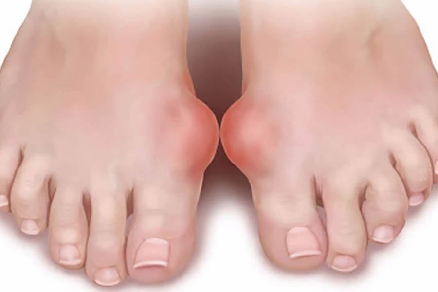 Bệnh Gout Mãn Tính Và Tất Tần Tật Thông Tin Mà Bạn Cần Biết