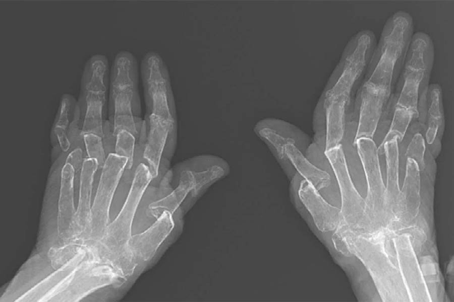Bệnh Gout Mãn Tính Và Tất Tần Tật Thông Tin Mà Bạn Cần Biết