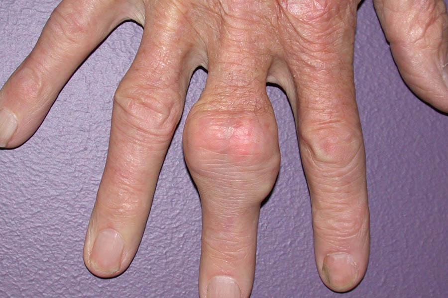 Dấu Hiệu Bệnh Gout Ở Chân Cần Lưu Ý Để Chữa Trị Kịp Thời 3 Dấu Hiệu Bệnh Gout Ở Chân Cần Lưu Ý Để Chữa Trị Kịp Thời