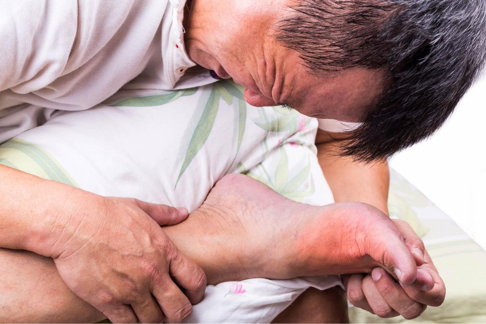 Dấu Hiệu Bệnh Gout Ở Chân Cần Lưu Ý Để Chữa Trị Kịp Thời 4 Dấu Hiệu Bệnh Gout Ở Chân Cần Lưu Ý Để Chữa Trị Kịp Thời