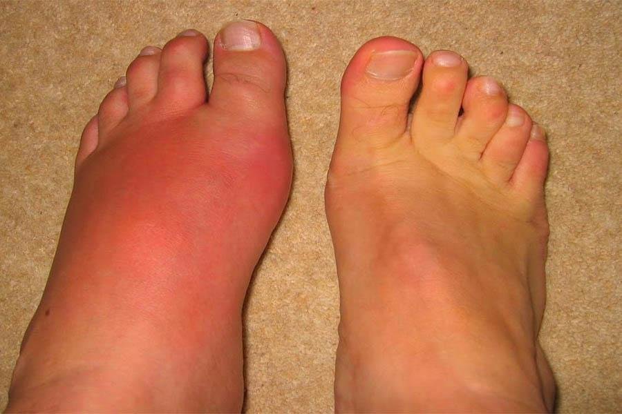 Dấu Hiệu Bệnh Gout Ở Chân Cần Lưu Ý Để Chữa Trị Kịp Thời 5 Dấu Hiệu Bệnh Gout Ở Chân Cần Lưu Ý Để Chữa Trị Kịp Thời