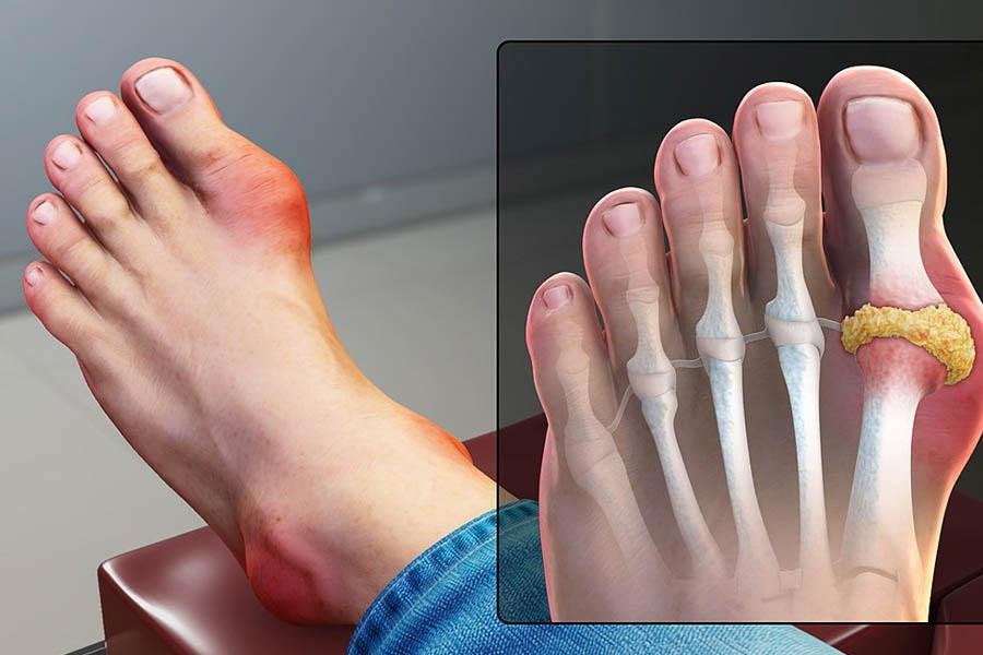 Người Bệnh Gout Nên Ăn Gì Để Cải Thiện Tình Trạng Bệnh
