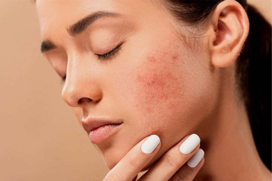 Sản phẩm Collagen Nào Tốt Cho Da Mụn 2022?