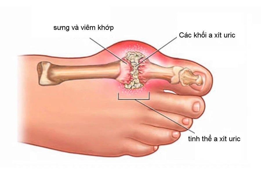 Thực Đơn Cho Người Bệnh Gout Để Hỗ Trợ Điều Trị Gout Hiệu Quả 2 Thực Đơn Cho Người Bệnh Gout Để Hỗ Trợ Điều Trị Gout Hiệu Quả